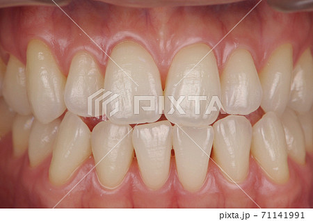 美しい天然歯 71141991
