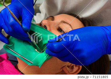 The dentist installs a rubber dam, sterile dental treatment, modern equipment in dentistry. The dentist installs a rubber dam, sterile dental treatment, modern equipment in dentistry. 71151805