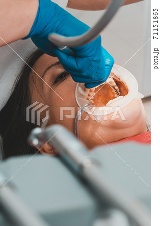 After cleaning the teeth from tartar, the dentist rinses them with water, using only sterile instruments. After cleaning the teeth from tartar, the dentist rinses them with water, using only sterile instruments. 71151865
