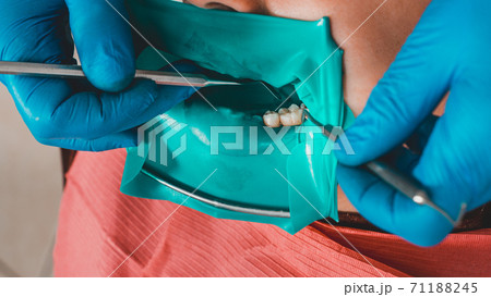 The dentist installs a rubber dam, sterile dental treatment, modern equipment in dentistry. 71188245