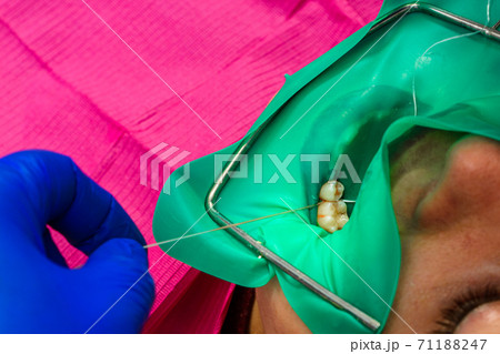 Installation of a cofferdam to the patient, modern dental equipment, treatment in sterile conditions. Installation of a cofferdam to the patient, modern dental equipment, treatment in sterile conditions. 71188247
