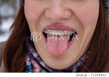 brasket system in smiling mouth, macro photo teeth, close-up lips, brasket system in smiling mouth, macro photo teeth, close-up lips, 71269832