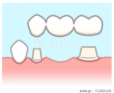 ブリッジ　図解 71282129