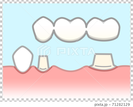 ブリッジ　図解 71282129