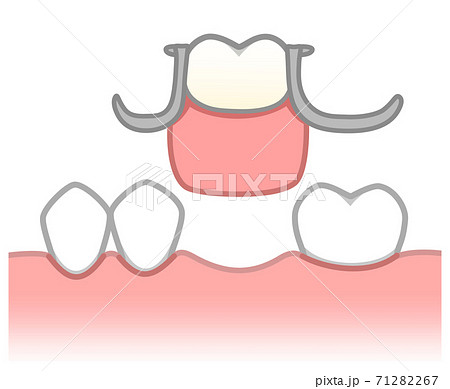 部分入れ歯　図解 71282267