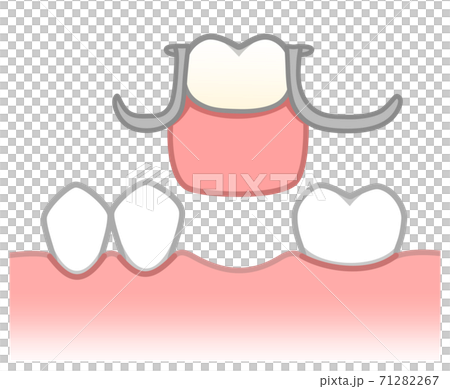 部分入れ歯　図解 71282267