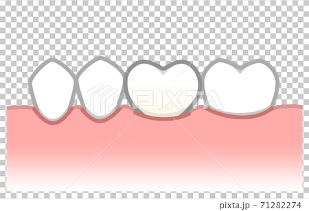 植入物圖 71282274
