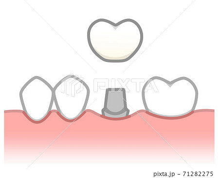 インプラント　図解 71282275