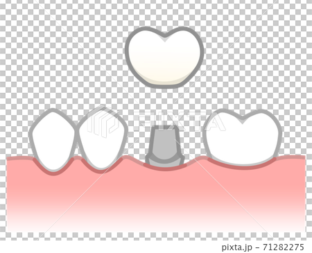 インプラント　図解 71282275