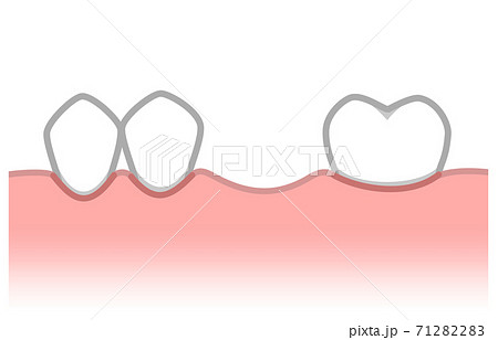 抜歯したあと歯がない状態のイラスト素材 7122
