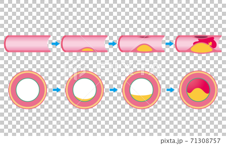 血管閉塞 動脈硬化の進行 血管閉塞 動脈硬化の進行 71308757