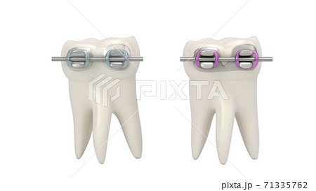 dental braces with plastic and metal base are installed on the tooth 3d render on white no shadow dental braces with plastic and metal base are installed on the tooth 3d render on white no shadow 71335762