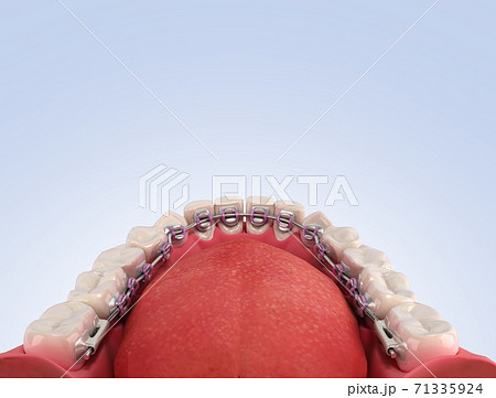 Lingual braces system on a demonstration denture 3d on color gradient 71335924