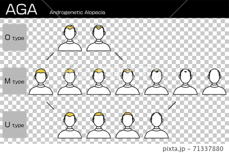 AGA　男性型脱毛症の各タイプと進行ステージのイラスト 71337880