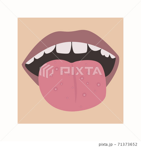 Fungus or acne on the tongue. Vector of a child's mouth with a disease. Fungus or acne on the tongue. Vector of a child's mouth with a disease. 71373652