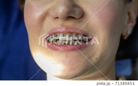 A woman at a dentist's appointment to replace arches with braces. 71380853