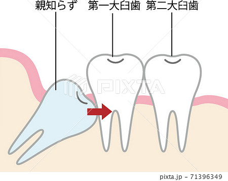 奥歯を圧迫する親知らずのイラスト 奥歯を圧迫する親知らずのイラスト 71396349