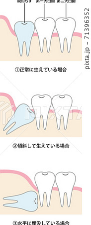 親知らずのタイプのイラスト 71396352