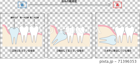 親知らず抜歯の難易度のイラスト素材