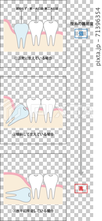 Difficulty of wisdom tooth extraction Difficulty of wisdom tooth extraction 71396354