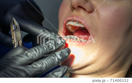 A woman at a dentist's appointment to replace arches with braces. 71400152