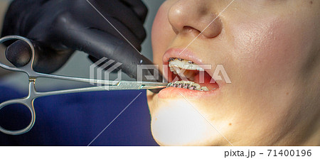 A woman at a dentist's appointment to replace arches with braces. 71400196