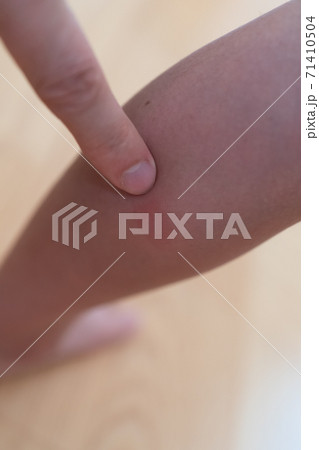 子供のふくらはぎの虫刺され痕 子供のふくらはぎの虫刺され痕 71410504