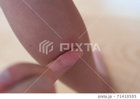 子供のふくらはぎの虫刺され痕に薬を塗る 子供のふくらはぎの虫刺され痕に薬を塗る 71410505