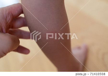 子供のふくらはぎの虫刺され痕 71410508