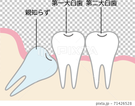 Wisdom tooth illustration - Stock Illustration [71426528] - PIXTA