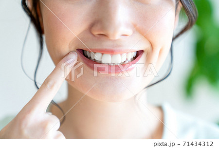 ホワイトニング ホワイトニング 71434312