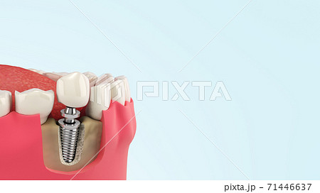 Tooth human single implant Dental concept Human teeth or dentures 3d render on blue gradient Tooth human single implant Dental concept Human teeth or dentures 3d render on blue gradient 71446637