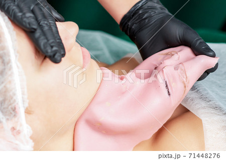 Removing alginate mask. 71448276