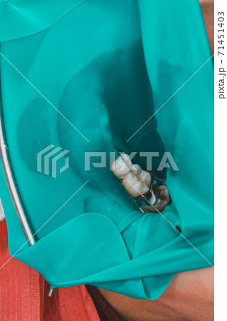 treatment of a chewing tooth, the dentist put a rubber dam, uses sterile tools, uses modern technology. treatment of a chewing tooth, the dentist put a rubber dam, uses sterile tools, uses modern technology. 71451403