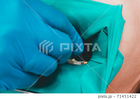 The dentist treats the patient's tooth with a rubber dam, drill, mirror. 71451422