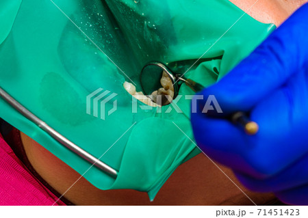 Treatment of posterior tooth, mouth covered with rubber dam, sterile treatment with modern technology. 71451423