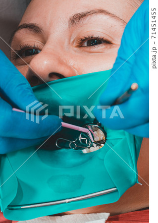 A patient at a dentist's appointment, a doctor uses a rubber dam to treat teeth, disinfects a tooth for filling. 71451455