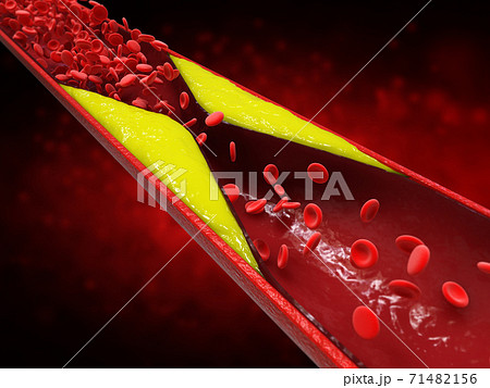 atherosclerosis with plaque in vessel 71482156