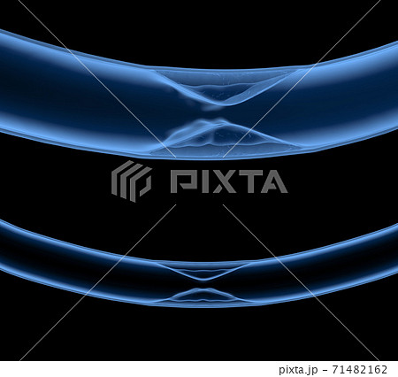 x-ray atherosclerosis with plaque in vessel 71482162