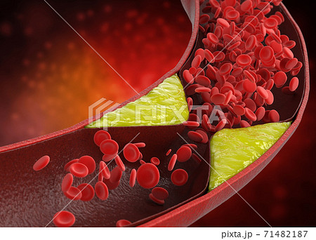 atherosclerosis with plaque in vessel atherosclerosis with plaque in vessel 71482187