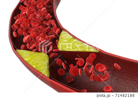 atherosclerosis with plaque in vessel 71482188