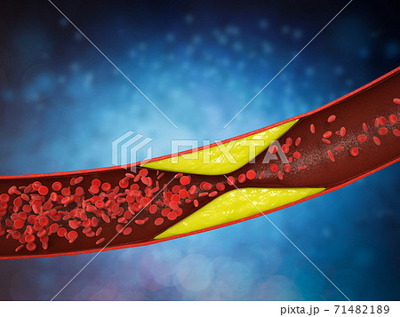 atherosclerosis with plaque in vessel 71482189