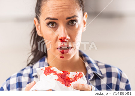 Young female with bleeding nose has blood all over tissue, her nose and mouth 71489001