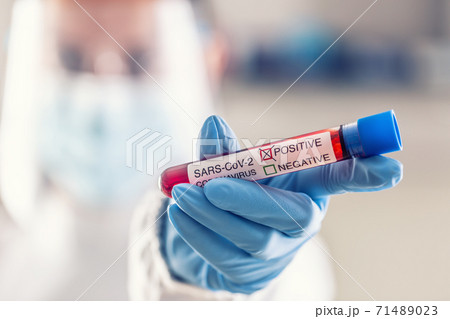 Ampule with a SARS-CoV2 coronavirus positive test in a hand of a medical worker 71489023