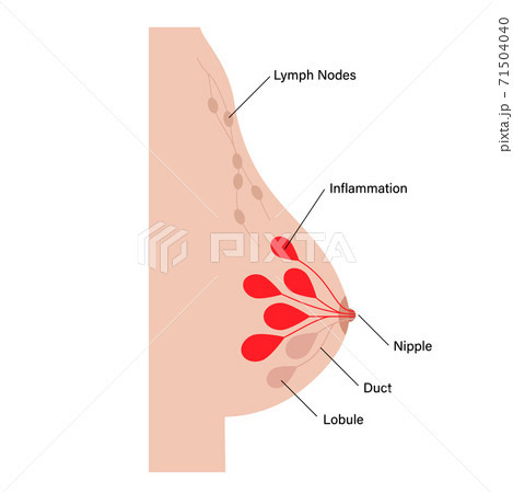Breast disease concept 71504040