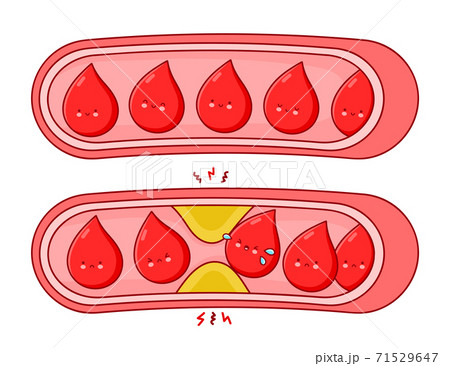 Normal and clogged blood vessels 71529647