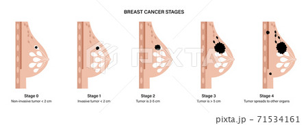 Breast disease concept 71534161