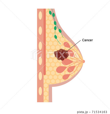 Breast disease concept 71534163