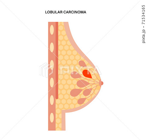 Breast disease concept 71534165