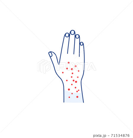 Skin rash thin line icon isolated on white background. Color outline hand palm Allergy eczema psoriasis dermatitis disease symptom sign. Skin condition design. Dermatology medicine illustration 71534876